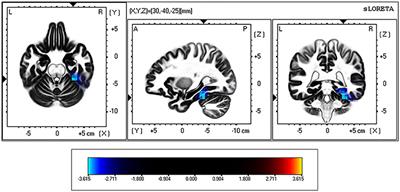 The Brain of Binge Drinkers at Rest: Alterations in Theta and Beta Oscillations in First-Year College Students with a Binge Drinking Pattern